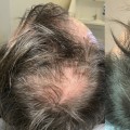 How often do you need exosomes for hair loss?