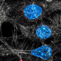 The Fascinating Role of Exosomes in Cancer Progression and Treatment