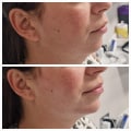 The Power of Combining Polynucleotide and Botox Treatments for Comprehensive Skin Rejuvenation