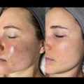 How much does an exosome facial cost?