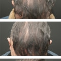 The Long-Lasting Effects of Exosome Hair Therapy: An Expert's Perspective