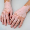 Does stem cell therapy work for vitiligo?