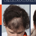 The Revolutionary Solution for Hair Loss: Exosome Therapy