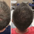 Are exosomes better than hair transplants?
