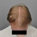 What are the side effects of exosomes for hair?