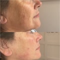 The Power of Polynucleotides: How They Tighten and Rejuvenate Your Skin