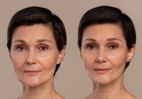 Do exosomes get rid of wrinkles?