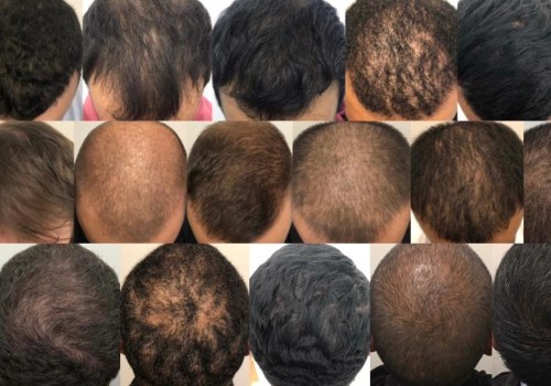 Do exosomes really work for hair growth?