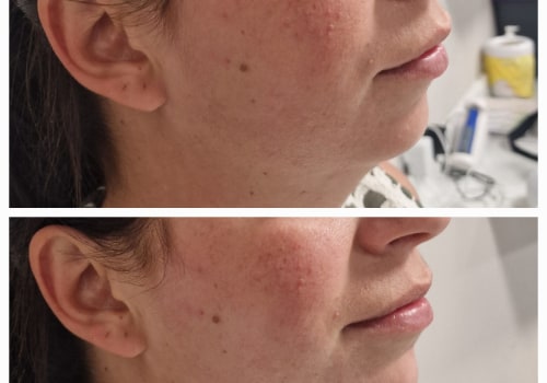 The Power of Combining Polynucleotide and Botox Treatments for Comprehensive Skin Rejuvenation