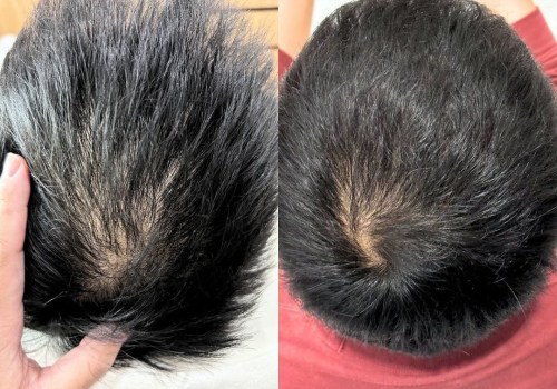 What is the difference between exosomes and regenera hair treatment?