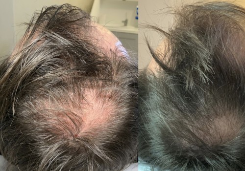 How to use exosomes for hair growth?