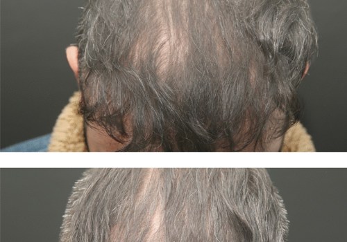 The Long-Lasting Effects of Exosome Hair Therapy: An Expert's Perspective