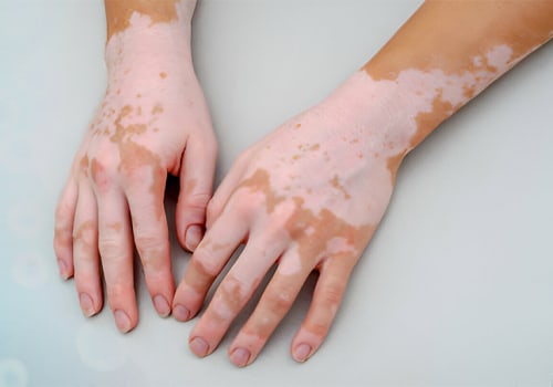 Does stem cell therapy work for vitiligo?
