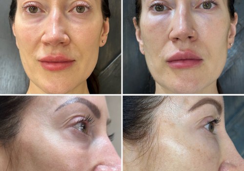How many sessions of exosomes for skin?