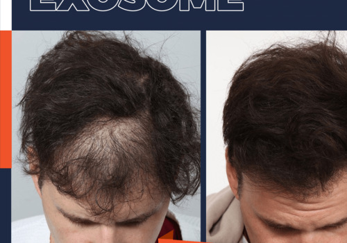 The Revolutionary Solution for Hair Loss: Exosome Therapy