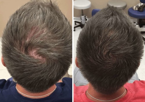 Are exosomes better than hair transplants?