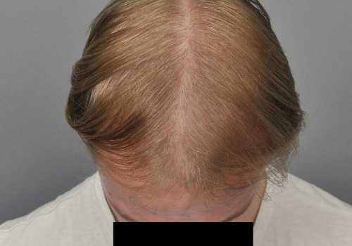 What are the side effects of exosomes for hair?