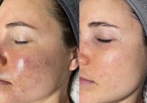 What are the side effects of exosomes in skincare?