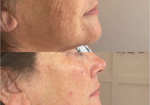 The Power of Polynucleotides: How They Tighten and Rejuvenate Your Skin